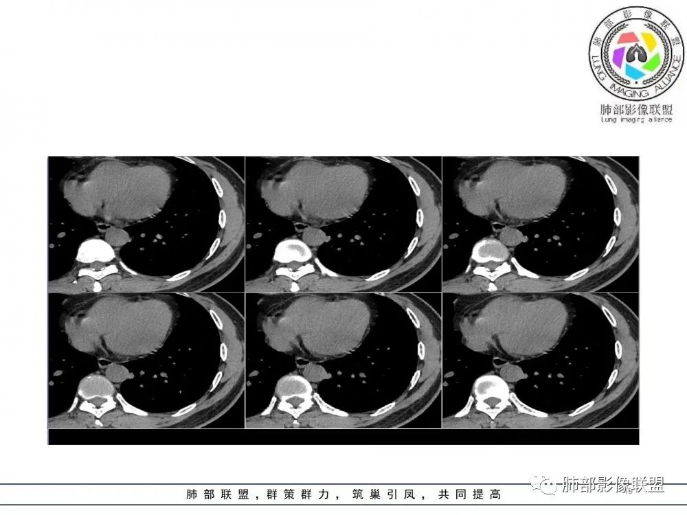 【病例】肺隐球菌病2例CT影像讨论 【病例】肺隐球菌病2例CT影像讨论