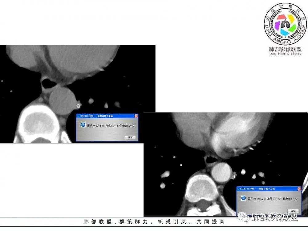 【病例】肺隐球菌病2例CT影像讨论 【病例】肺隐球菌病2例CT影像讨论