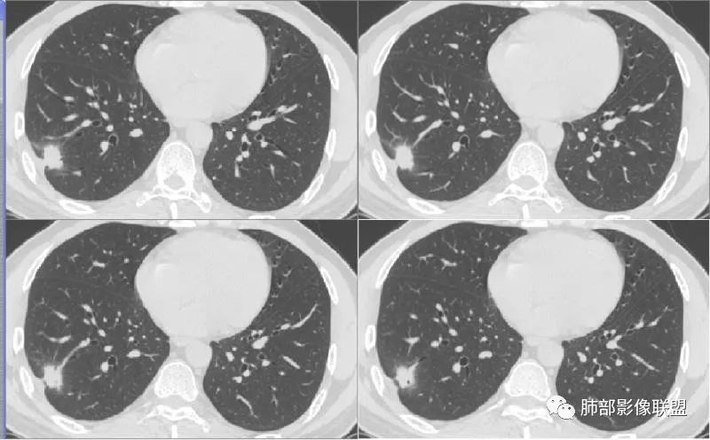 【病例】肺隐球菌病2例CT影像讨论 【病例】肺隐球菌病2例CT影像讨论