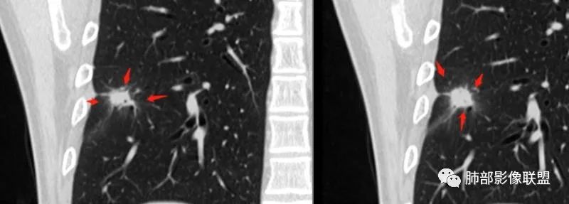 【病例】肺隐球菌病2例CT影像讨论 【病例】肺隐球菌病2例CT影像讨论