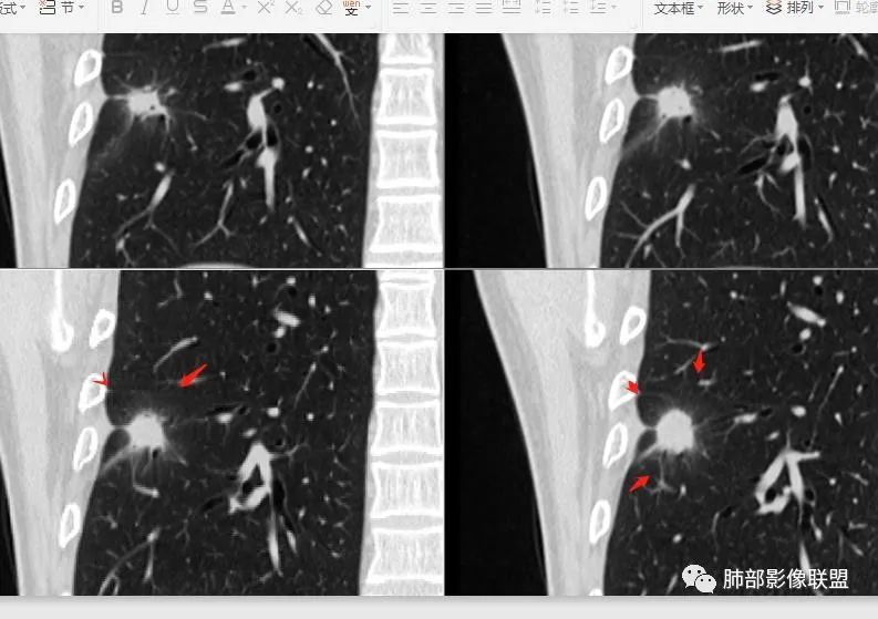 【病例】肺隐球菌病2例CT影像讨论 【病例】肺隐球菌病2例CT影像讨论
