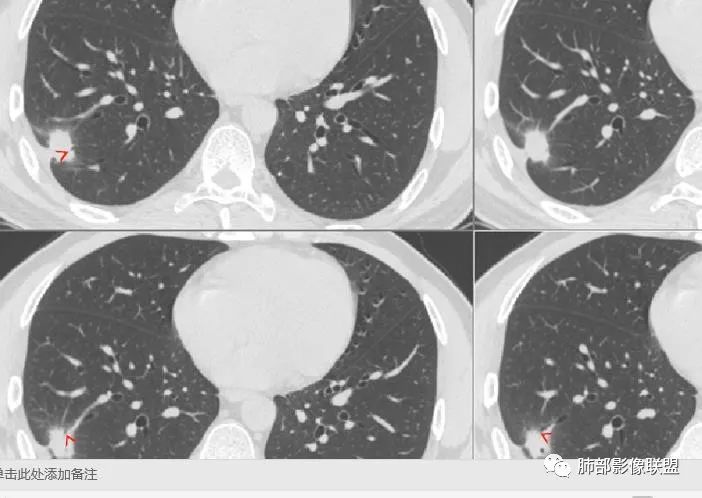 【病例】肺隐球菌病2例CT影像讨论 【病例】肺隐球菌病2例CT影像讨论