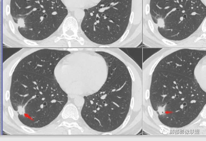 【病例】肺隐球菌病2例CT影像讨论 【病例】肺隐球菌病2例CT影像讨论