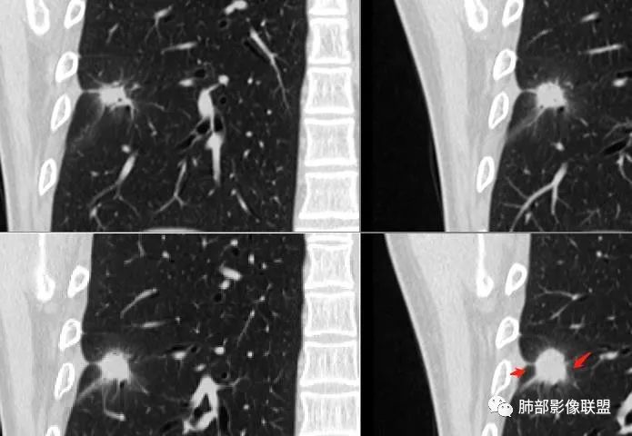 【病例】肺隐球菌病2例CT影像讨论 【病例】肺隐球菌病2例CT影像讨论