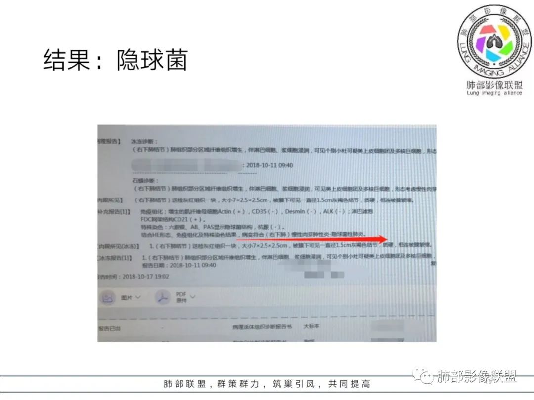 【病例】肺隐球菌病2例CT影像讨论 【病例】肺隐球菌病2例CT影像讨论