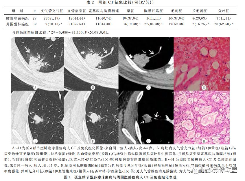 【病例】肺隐球菌病2例CT影像讨论 【病例】肺隐球菌病2例CT影像讨论