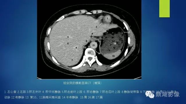 腹部CT超全断层解剖