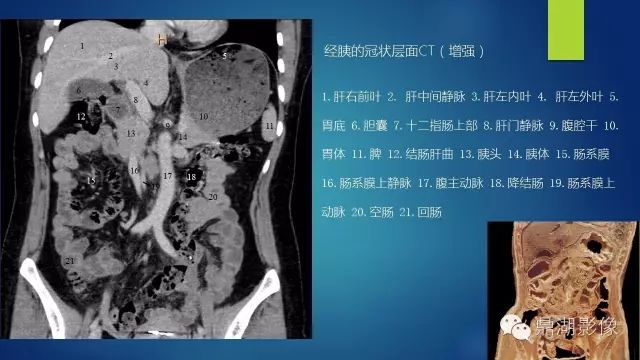 腹部CT超全断层解剖