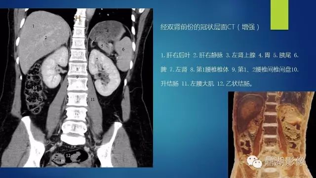 腹部CT超全断层解剖