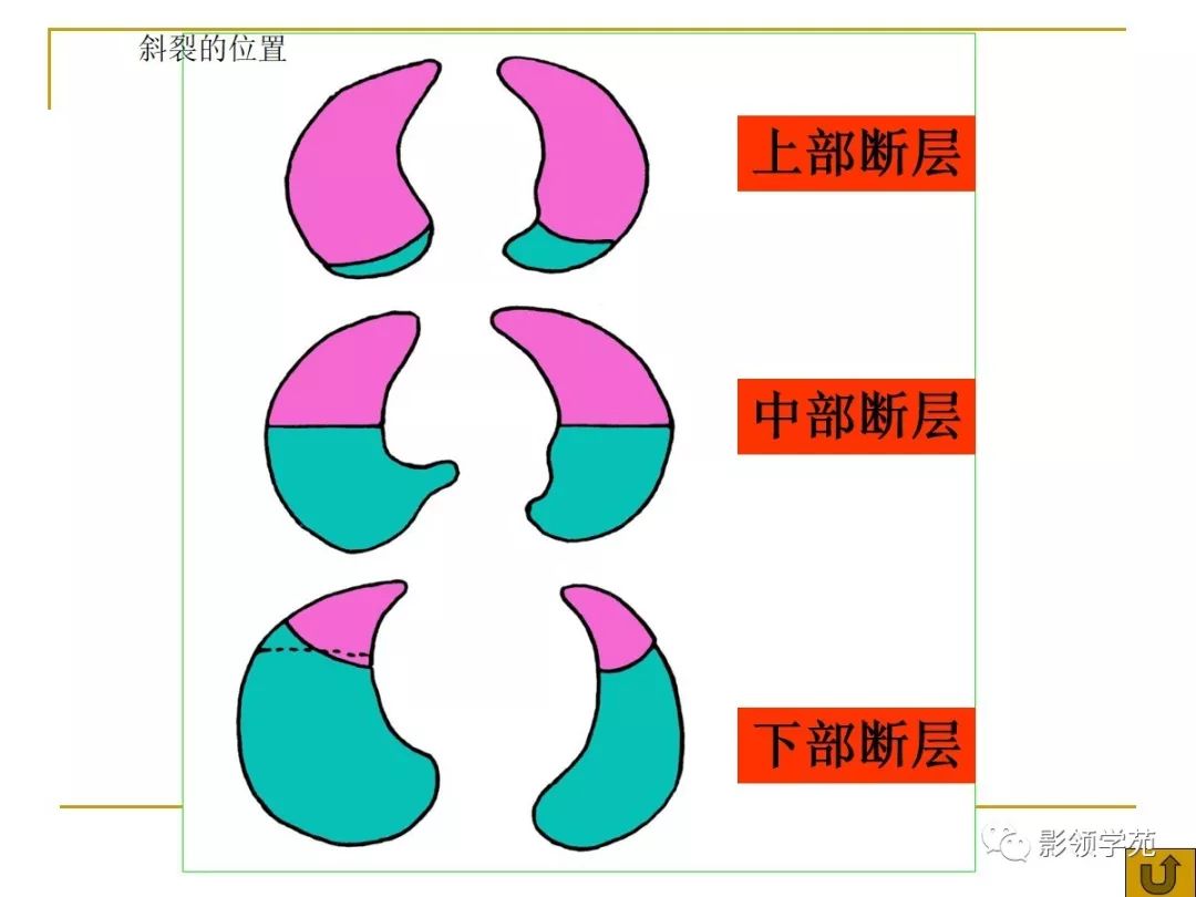 肺段与肺内管道应用解剖 肺段与肺内管道应用解剖