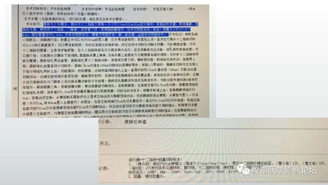 【病例】胰头部神经内分泌肿瘤1例CT影像 【病例】胰头部神经内分泌肿瘤1例CT影像