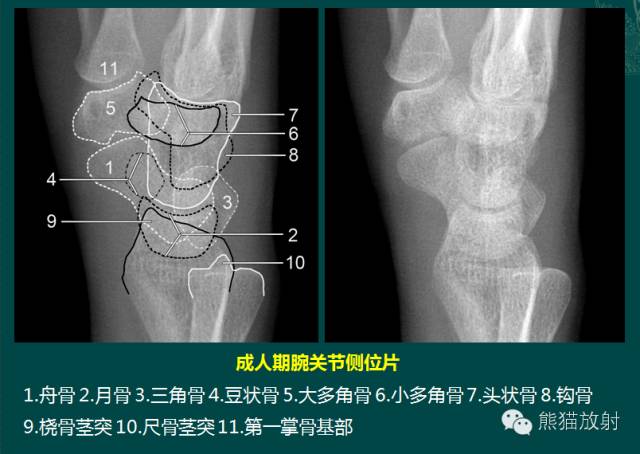 腕骨脱位的分类及X线表现
