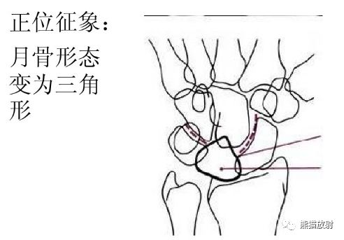 腕骨脱位的分类及X线表现