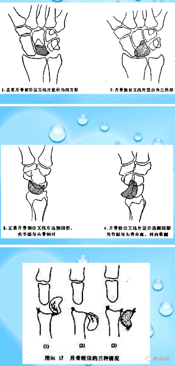 腕骨脱位的分类及X线表现