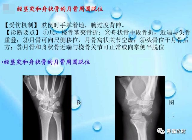 腕骨脱位的分类及X线表现