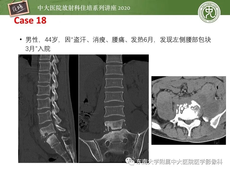 【PPT】脊柱骨源性病变影像分析思路及应用