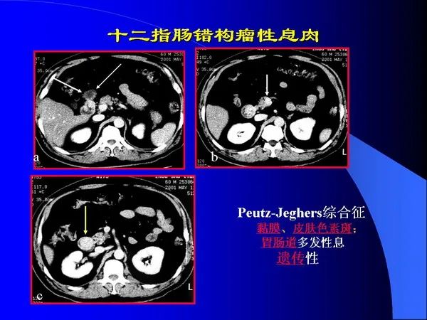 【PPT】小肠良恶性肿瘤CT诊断