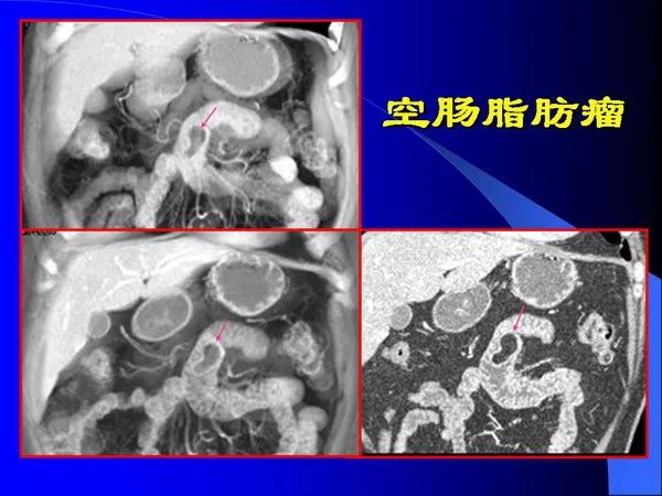 【PPT】小肠良恶性肿瘤CT诊断