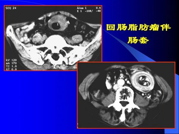 【PPT】小肠良恶性肿瘤CT诊断
