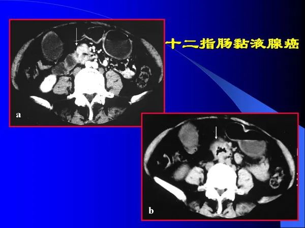【PPT】小肠良恶性肿瘤CT诊断