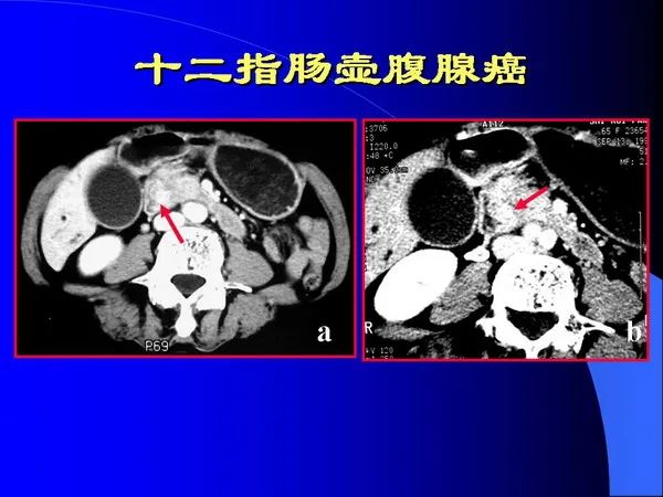 【PPT】小肠良恶性肿瘤CT诊断