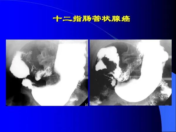 【PPT】小肠良恶性肿瘤CT诊断