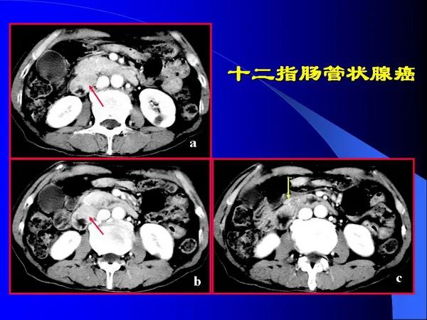 【PPT】小肠良恶性肿瘤CT诊断