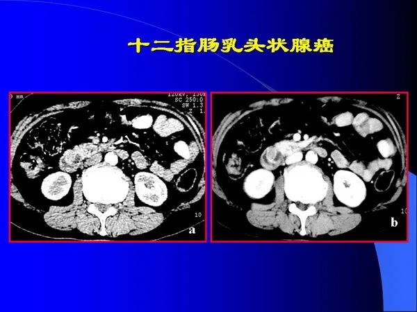 【PPT】小肠良恶性肿瘤CT诊断
