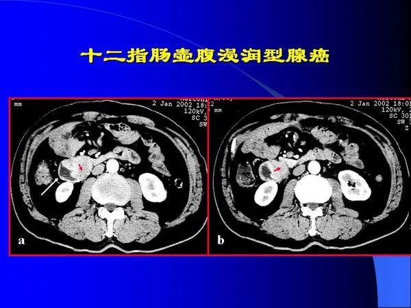 【PPT】小肠良恶性肿瘤CT诊断