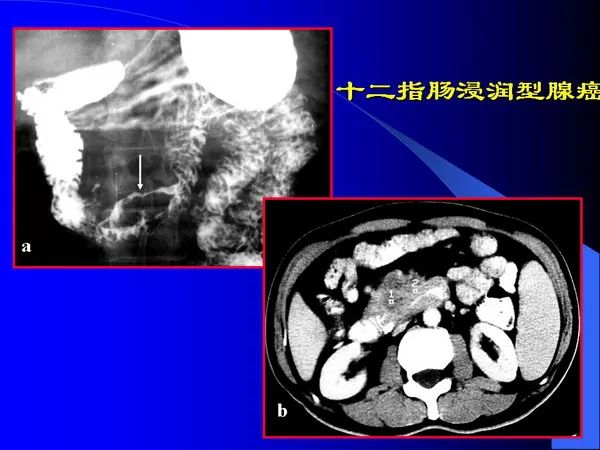 【PPT】小肠良恶性肿瘤CT诊断