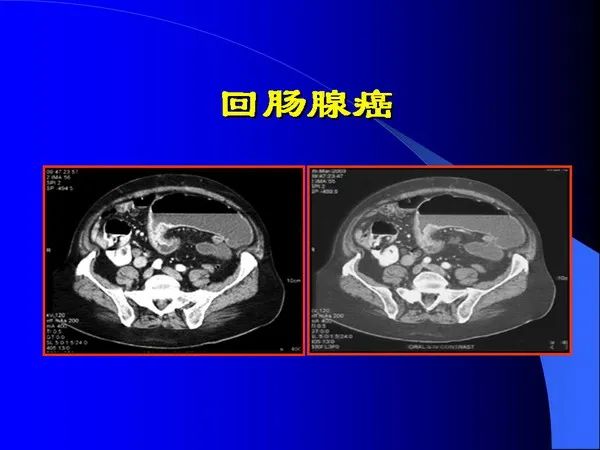 【PPT】小肠良恶性肿瘤CT诊断