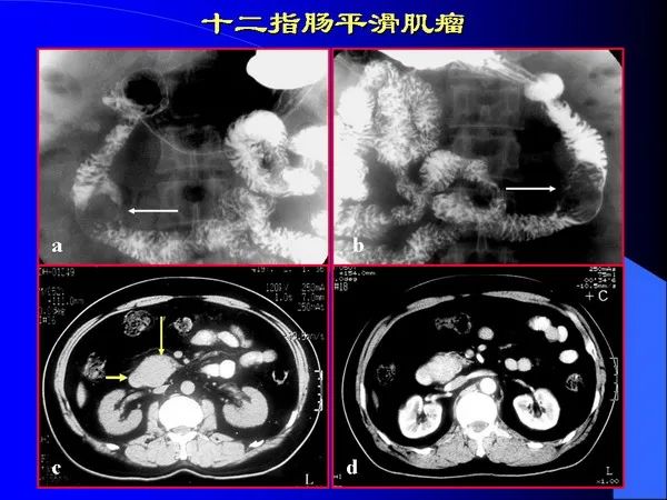【PPT】小肠良恶性肿瘤CT诊断