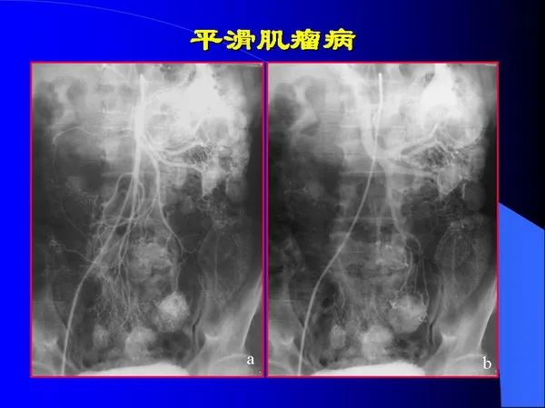 【PPT】小肠良恶性肿瘤CT诊断