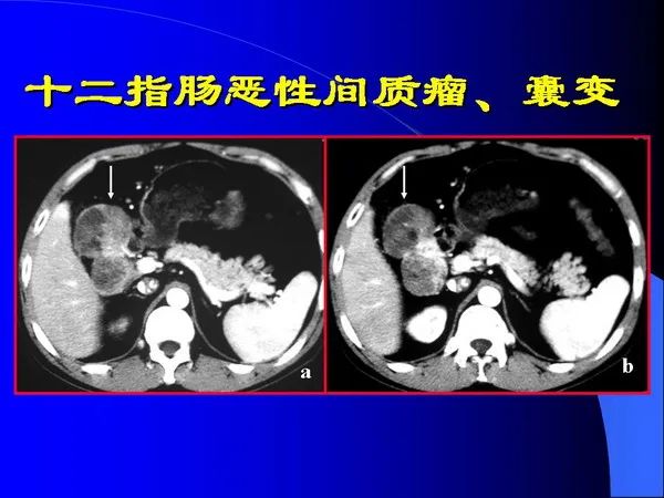 【PPT】小肠良恶性肿瘤CT诊断