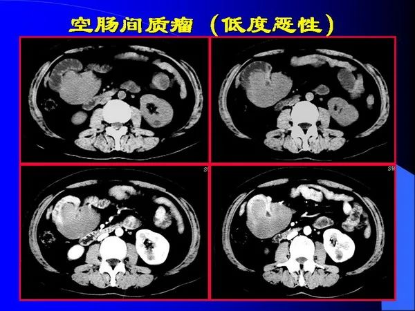 【PPT】小肠良恶性肿瘤CT诊断