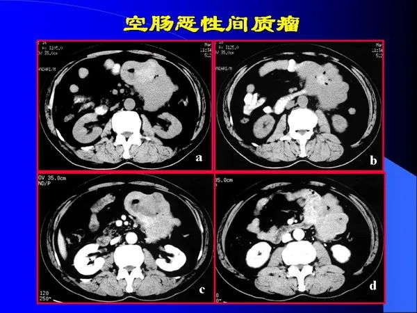 【PPT】小肠良恶性肿瘤CT诊断