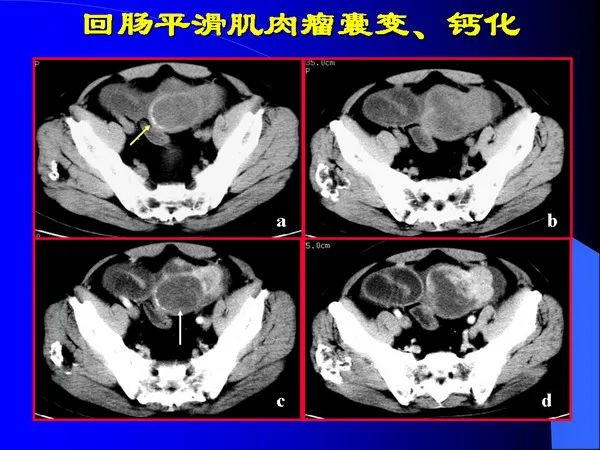 【PPT】小肠良恶性肿瘤CT诊断