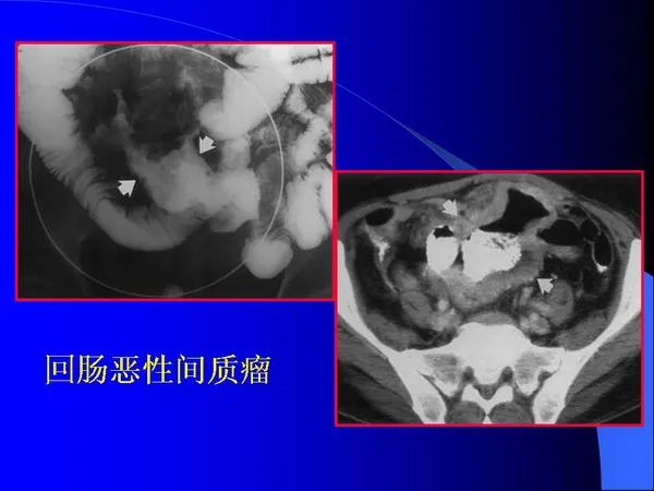 【PPT】小肠良恶性肿瘤CT诊断