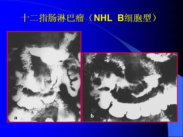 【PPT】小肠良恶性肿瘤CT诊断