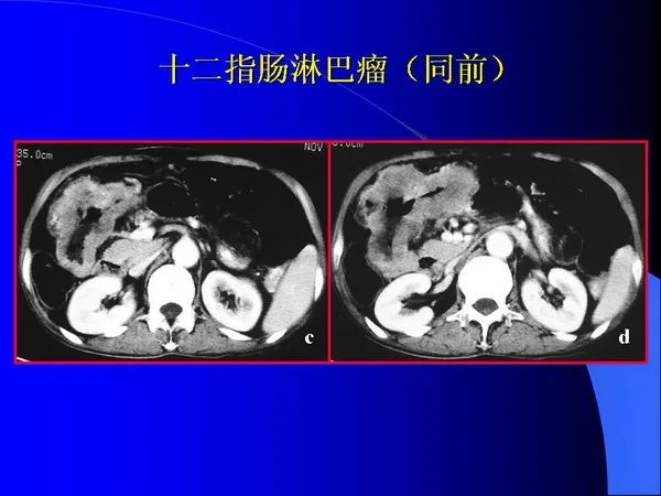 【PPT】小肠良恶性肿瘤CT诊断