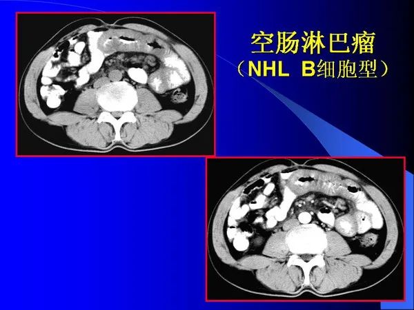 【PPT】小肠良恶性肿瘤CT诊断