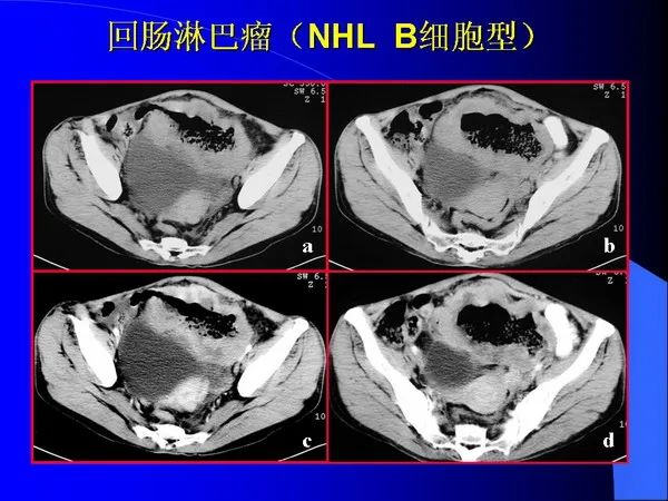 【PPT】小肠良恶性肿瘤CT诊断
