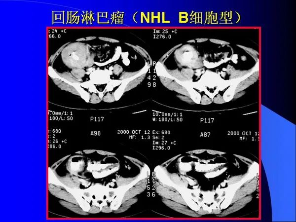 【PPT】小肠良恶性肿瘤CT诊断
