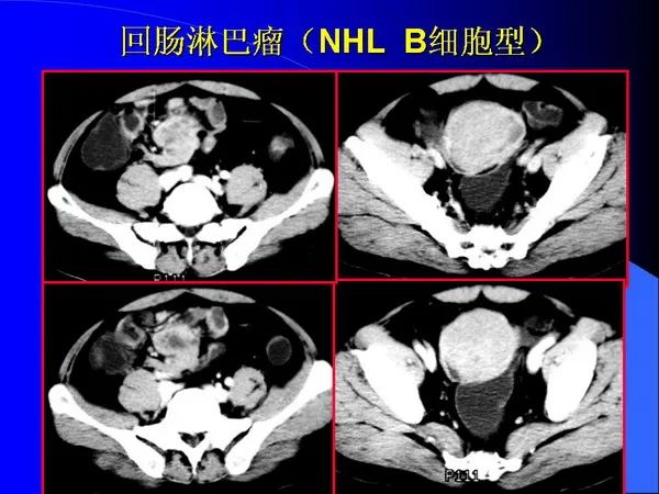 【PPT】小肠良恶性肿瘤CT诊断