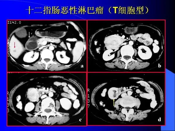 【PPT】小肠良恶性肿瘤CT诊断