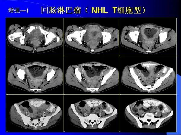 【PPT】小肠良恶性肿瘤CT诊断