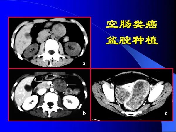 【PPT】小肠良恶性肿瘤CT诊断