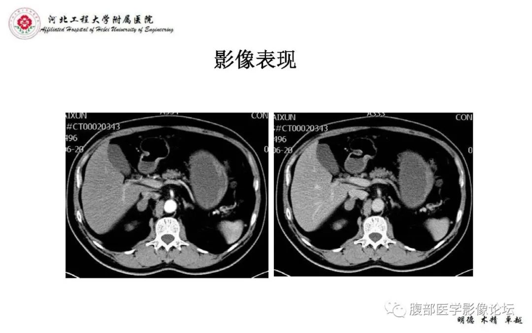 【PPT】肾上腺神经鞘瘤