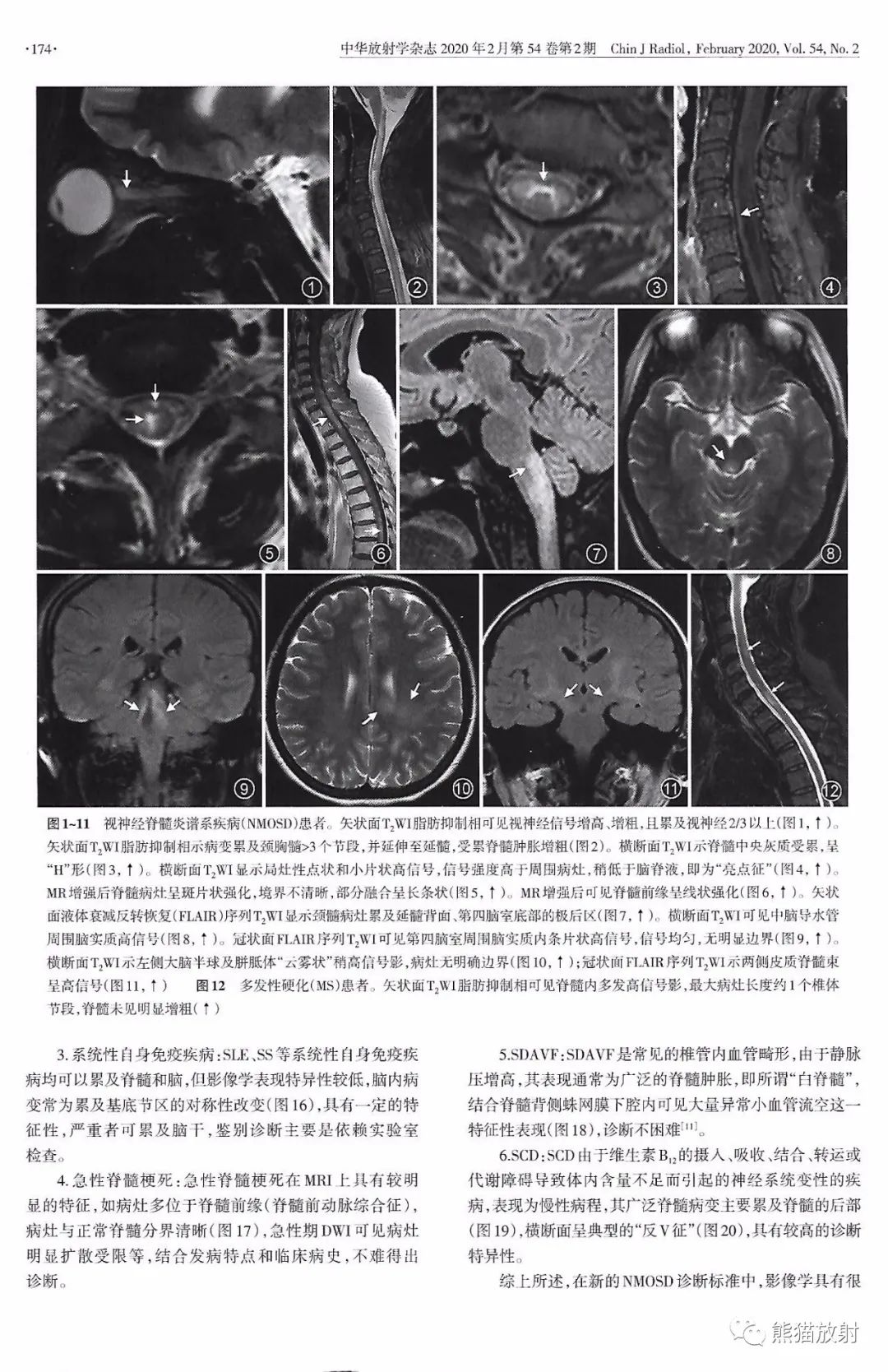 视神经脊髓炎谱系疾病的影像学诊断与鉴别诊断 视神经脊髓炎谱系疾病的影像学诊断与鉴别诊断