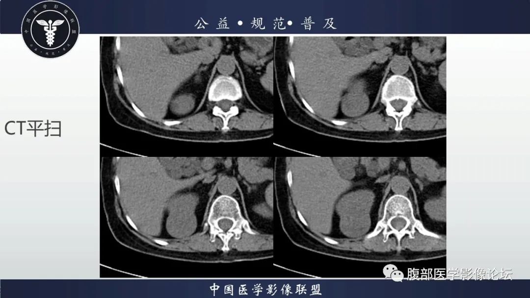 【病例】肾脏乳头状肾细胞癌1例CT及MR影像讨论 【病例】肾脏乳头状肾细胞癌1例CT及MR影像讨论